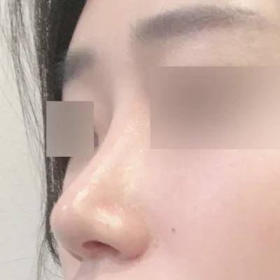 団子鼻の手術から3ヶ月になりました!!!