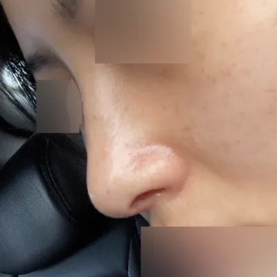 プロテーゼなしの鼻整形手術を受けました