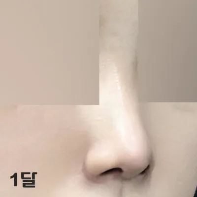 1ヶ月経つと、さらに腫れがどんどん引いていくみたいでーす。