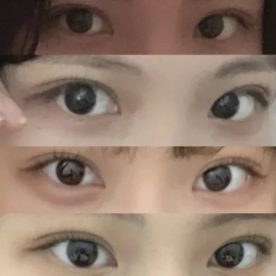 （自然癒着 目つき矯正 目頭切開）手術を受けてから4ヶ月