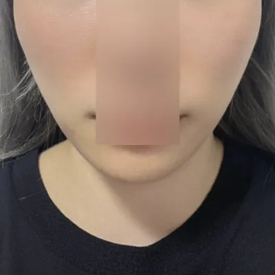 気になっていたほうれい線を解消しました〜