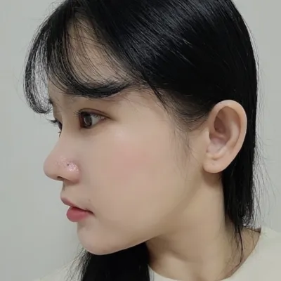 目と鼻の再手術から1ヶ月経ちました