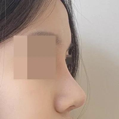 鼻の手術後3ヶ月のレビューです！