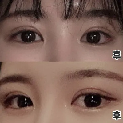 目が横に長くなりました！再手術成功後