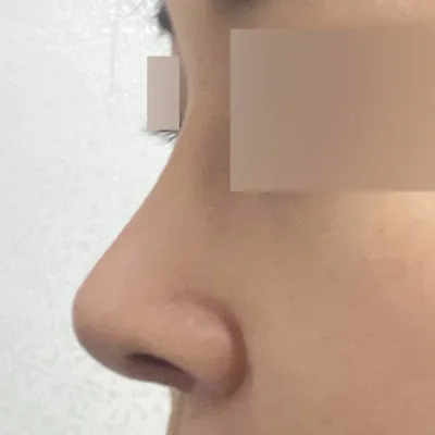 つままれたような鼻の再手術をしました