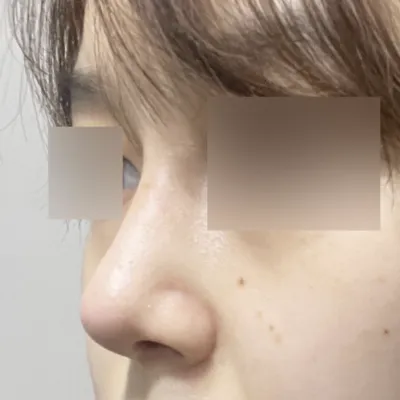 ウィーバース美容外科で鼻再手術を受けて1ヶ月目のレビューです~! 