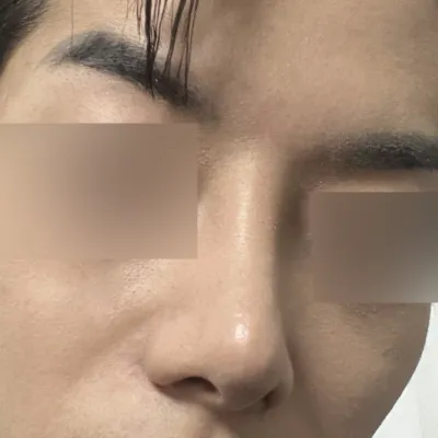 団子鼻の再手術に本当に満足しています。