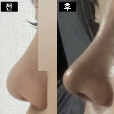 鼻の手術をしてから1ヶ月になりました ㅎ