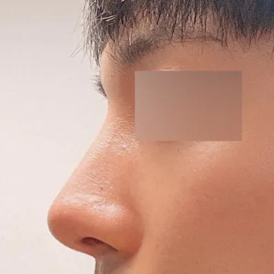 ウィーバース整形外科で手術を受けてから6ヶ月