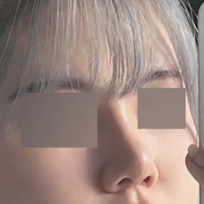 修正なしでも綺麗な鼻に感動+院長先生に感謝！