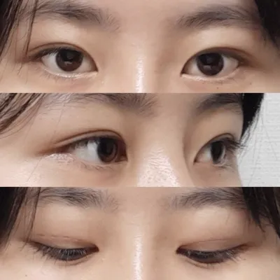 目も2週間で腫れが引き、傷跡もなくきれいです！