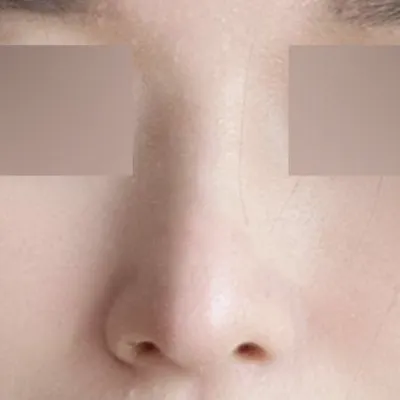 鼻の手術から6ヶ月も経ちました