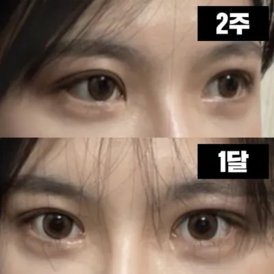 抜糸して時間が経つのがあっという間でした！