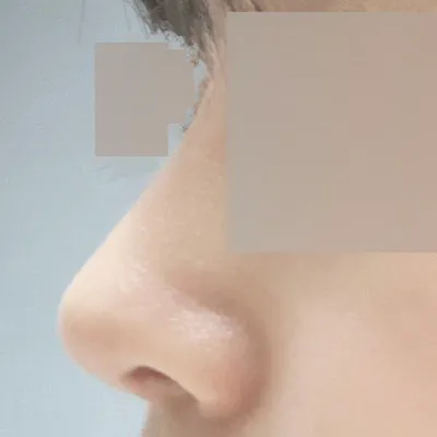 ウィーバース美容外科で鼻の手術をしてから早くも2ヶ月になりました