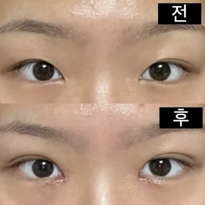 手術前後の写真はすべて基本カメラで撮影しました！