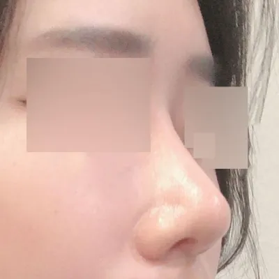 私の鼻が生えて半年後のレビューです！