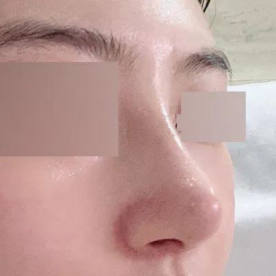 私の憧れの鼻にしてくださったソ・スンジョ院長先生ありがとうございます!