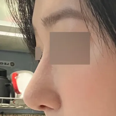 初めての鼻の手術で色々悩んだ末、ついに鼻の手術をしました。