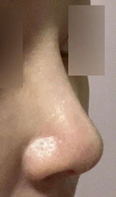 手術からもう6ヶ月経ちました