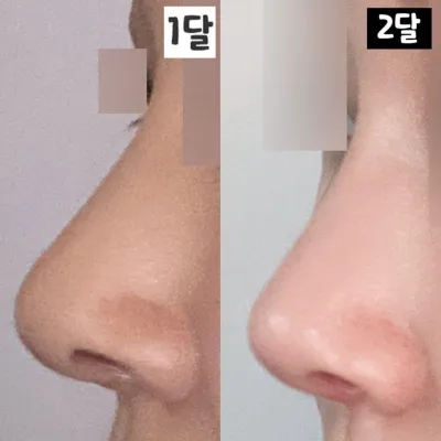 ウィーバース美容外科 鼻再手術2ヶ月目のレビュー