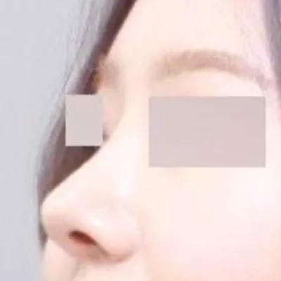 曲がったハンプノーズ手術をしてからもう6ヶ月になります（笑）