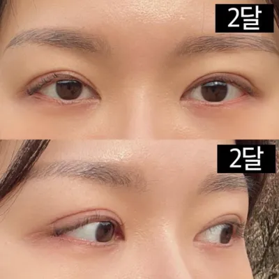 二重再手術と目つき矯正を受けました。