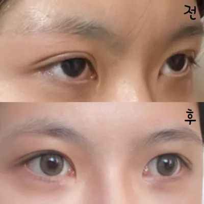 江南駅ウィーバース美容外科で目の再手術をしてから2ヶ月目です！