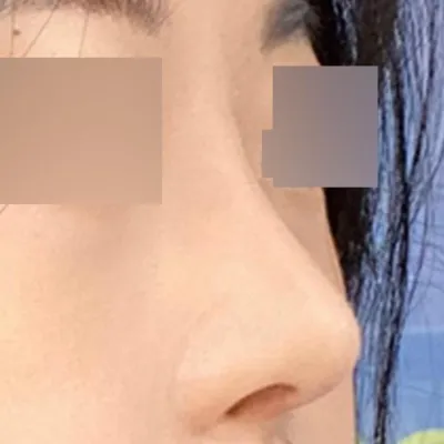 手術後2ヶ月経ちましたが、とても満足しています。