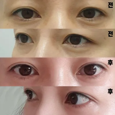 手術して良かったと改めて思います