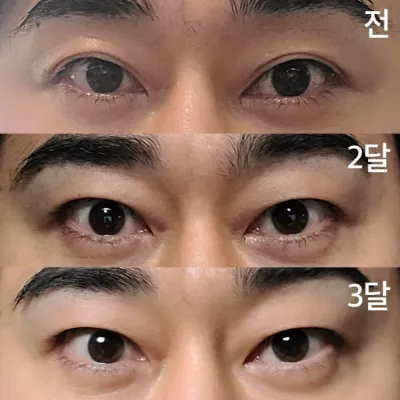 二重まぶた切開手術後3ヶ月目です。