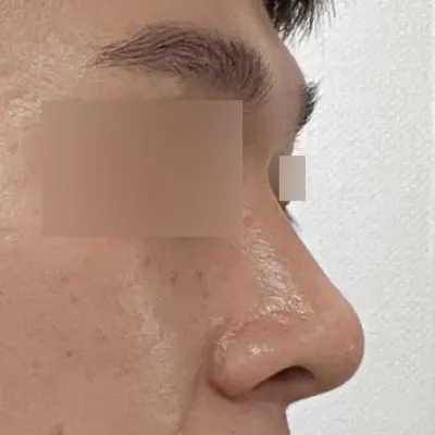 ソ・スンジョ院長に鼻の手術を受けて2ヶ月目です。