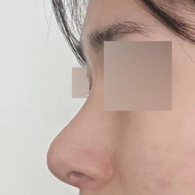 ウィーバース美容外科医院で鼻の手術をしてから2ヶ月目です。