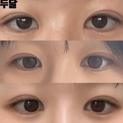 シム・ジョンファン院長に目と鼻の手術を受けてから2ヶ月後のレビューを残します