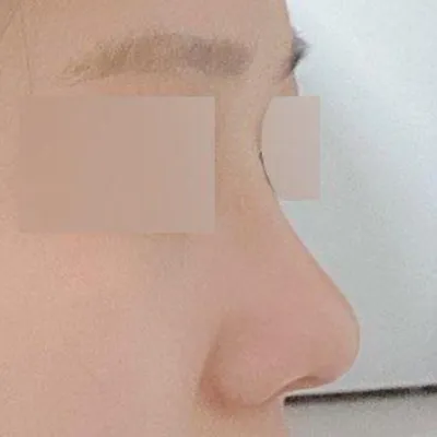鼻筋ができて横顔も綺麗になり、立体感も生まれました!