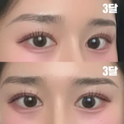 二重手術をして3ヶ月目です。