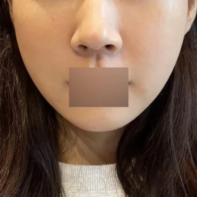 この程度なら腫れがあっても少ない方だと思います