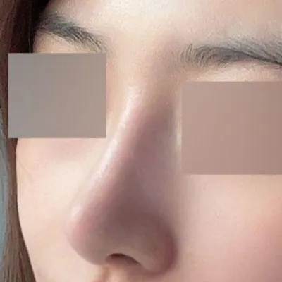 鼻の再手術後、問題なく3ヶ月経過しました（笑）