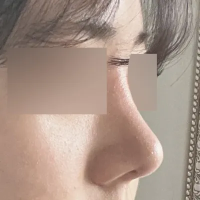 鼻再手術はウィーバースが最高です