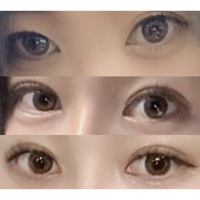 目の再手術、自然に成功しました！