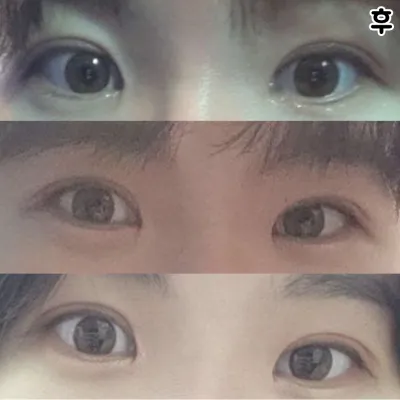 目が垂れて自信がなかったけど、手術して自信がつきましたㅠㅠㅠㅠ