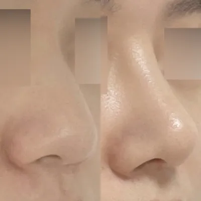 団子鼻にプロテーゼなしの手術を受けました