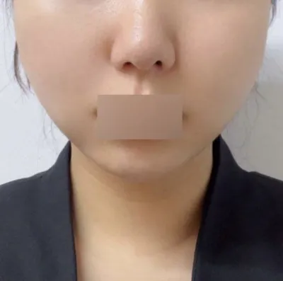 糸リフティングを受けて本当に良かった