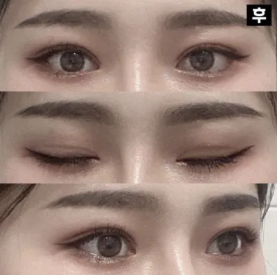 手術前より綺麗になって気に入って満足しています！