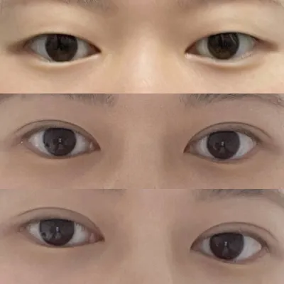 切開で細いラインに成功しました