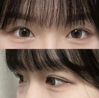 丁寧に相談してくれたので、ウィーバース美容外科で施術することにしました！