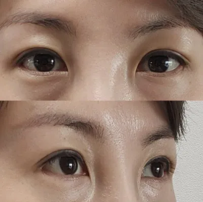 考えるととてもワクワクします！手術を受けてよかったと思います