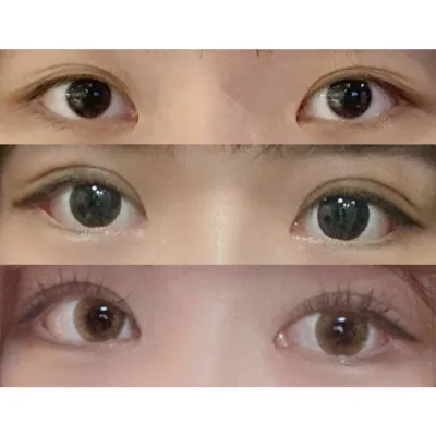 目尻切開＋自然癒着＋目つき矯正レビュー！