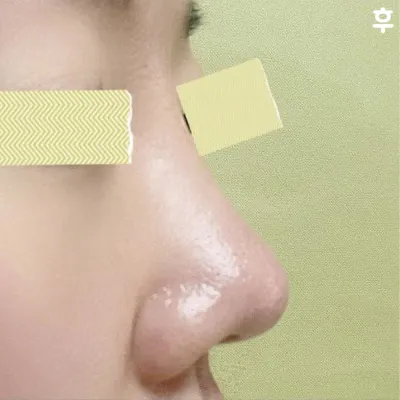 鼻の手術をして本当に人生で一番良い選択だったと思っています！