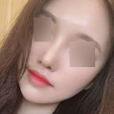 ウィーバースで鼻の手術をしてから3ヶ月になりました！