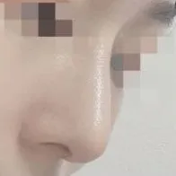プロテーゼなしでオ・ヨンソのような美しい直線ラインの鼻になりました!